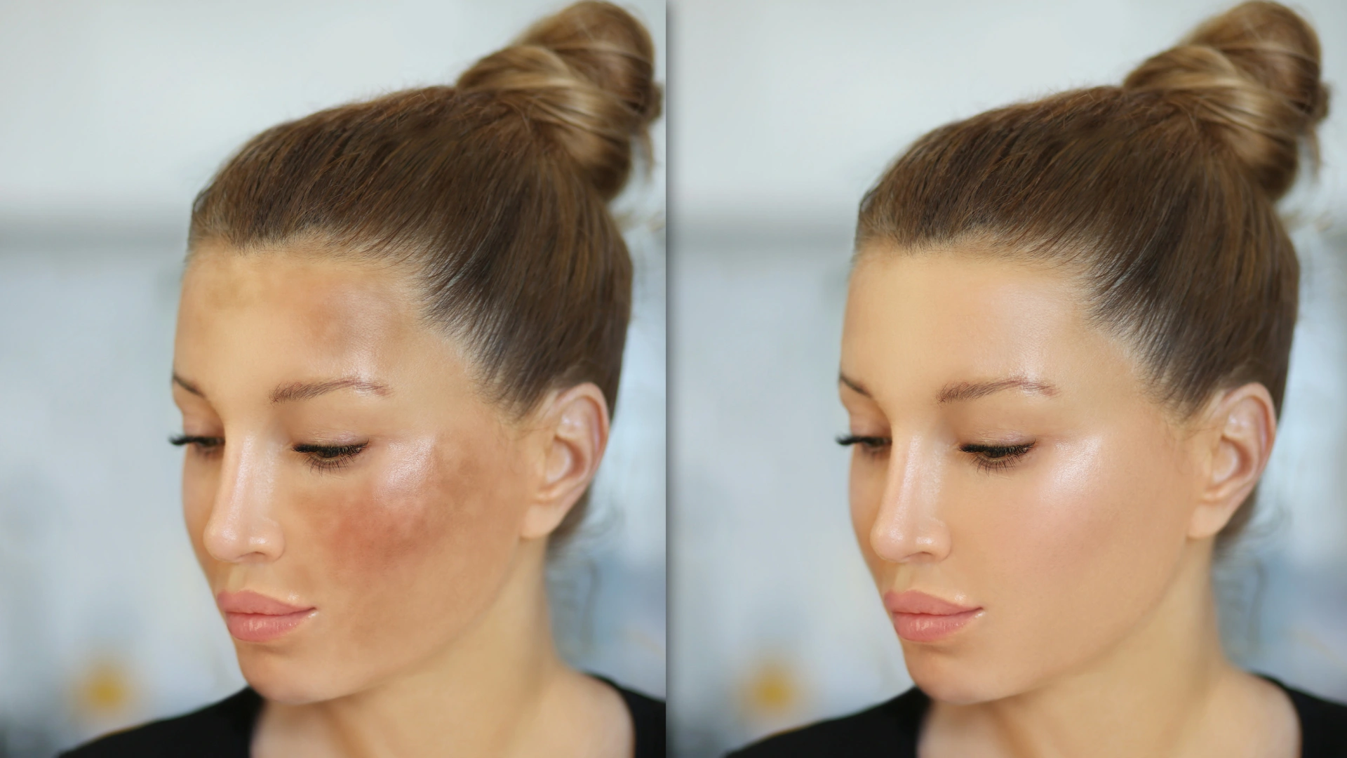 Effective removal of skin pigmentation at Laser Clinic.