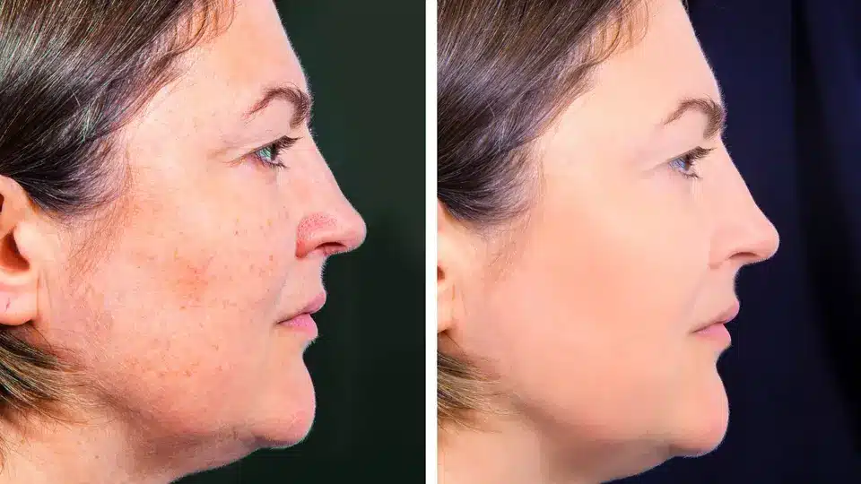 Effective removal of skin pigmentation at Laser Clinic.