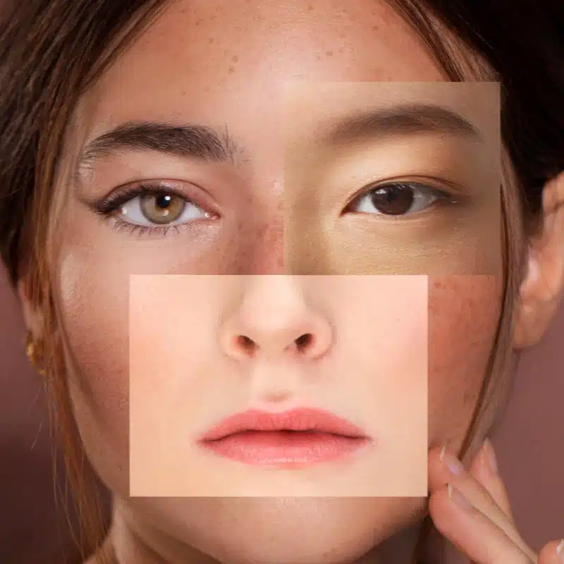 إزالة فعالة لتصبغات الجلد في عيادة الليزر.