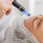 Professional Dermapen treatment for radiant skin at Laser Clinic.