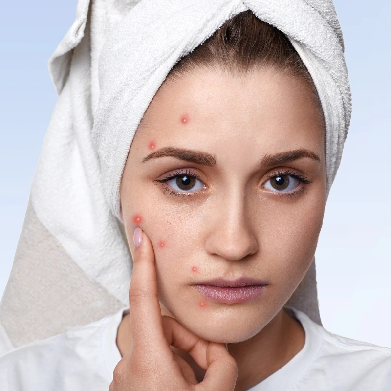 علاج فعال لحب الشباب للحصول على بشرة صافية في عيادة الليزر.