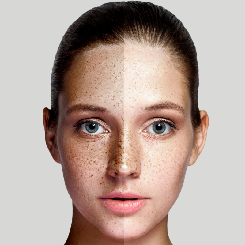 إزالة فعالة لتصبغات الجلد في عيادة الليزر.